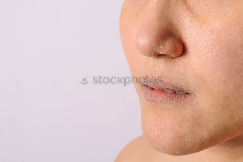 Similar – man’s chin with seborrheic dermatitis in beard