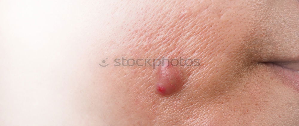 Similar – Image, Stock Photo a man with swollen eye from a bee sting