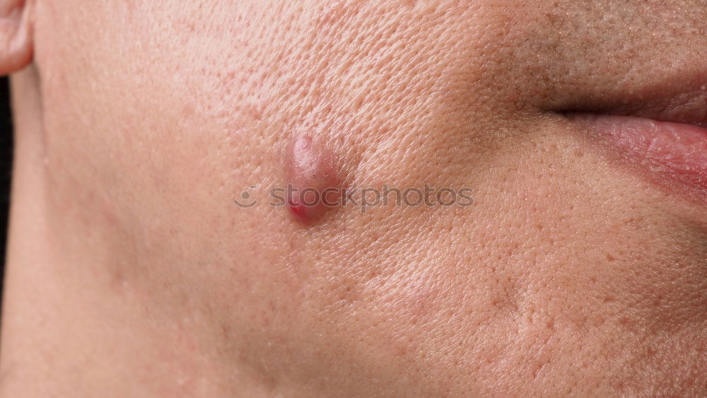 Similar – Image, Stock Photo a man with swollen eye from a bee sting