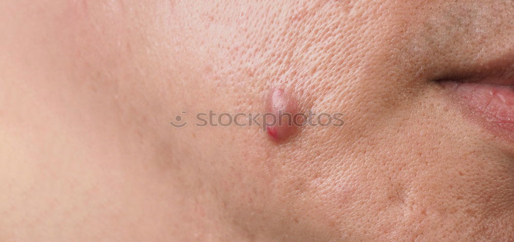 Similar – Image, Stock Photo a man with swollen eye from a bee sting