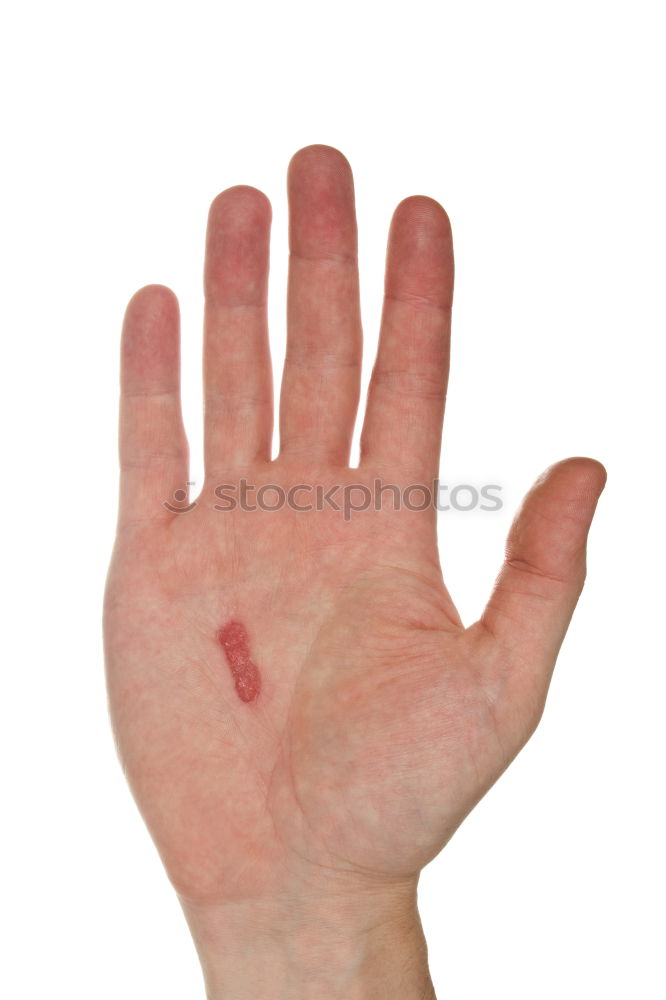 Similar – Foto Bild Mückenstich Hand