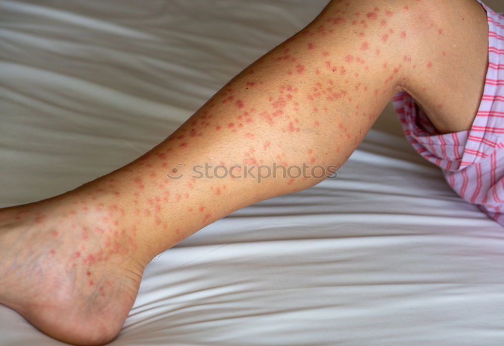 Similar – Foto Bild Mann mit krankem Arm, trockener schuppiger Haut an der Hand mit vulgären Psoriasis-Wunden, Allergie, Ekzem und anderen Hautkrankheiten wie Pilz, Plaque, Ausschlag und Unreinheiten. Genetische Autoimmunerkrankung.