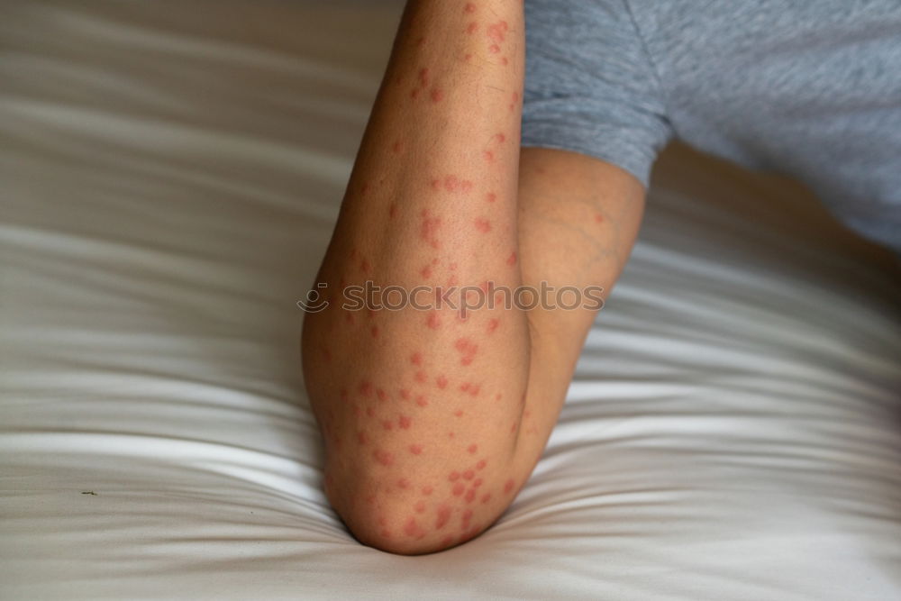 Similar – Foto Bild Mann mit krankem Arm, trockener schuppiger Haut an der Hand mit vulgären Psoriasis-Wunden, Allergie, Ekzem und anderen Hautkrankheiten wie Pilz, Plaque, Ausschlag und Unreinheiten. Genetische Autoimmunerkrankung.