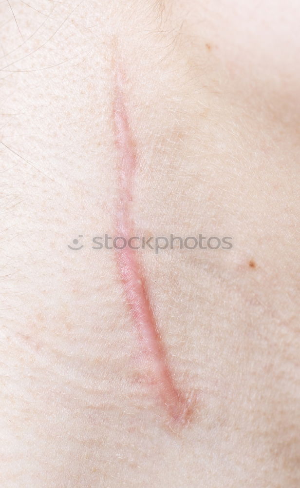 Similar – Ouch! Wound Scratch mark