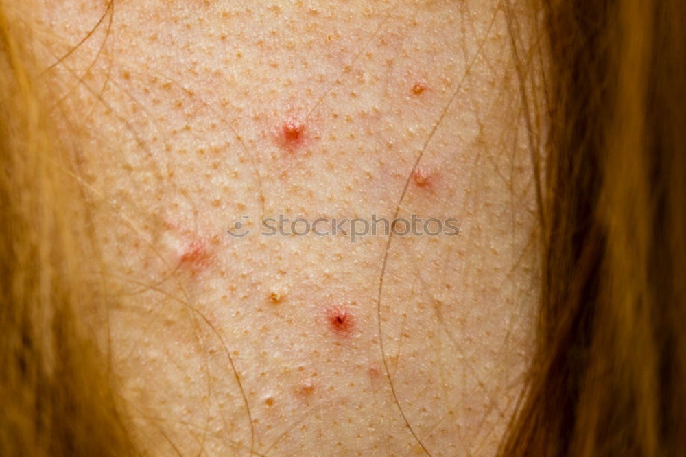 Similar – Foto Bild Mann mit krankem Arm, trockener schuppiger Haut an der Hand mit vulgären Psoriasis-Wunden, Allergie, Ekzem und anderen Hautkrankheiten wie Pilz, Plaque, Ausschlag und Unreinheiten. Genetische Autoimmunerkrankung.