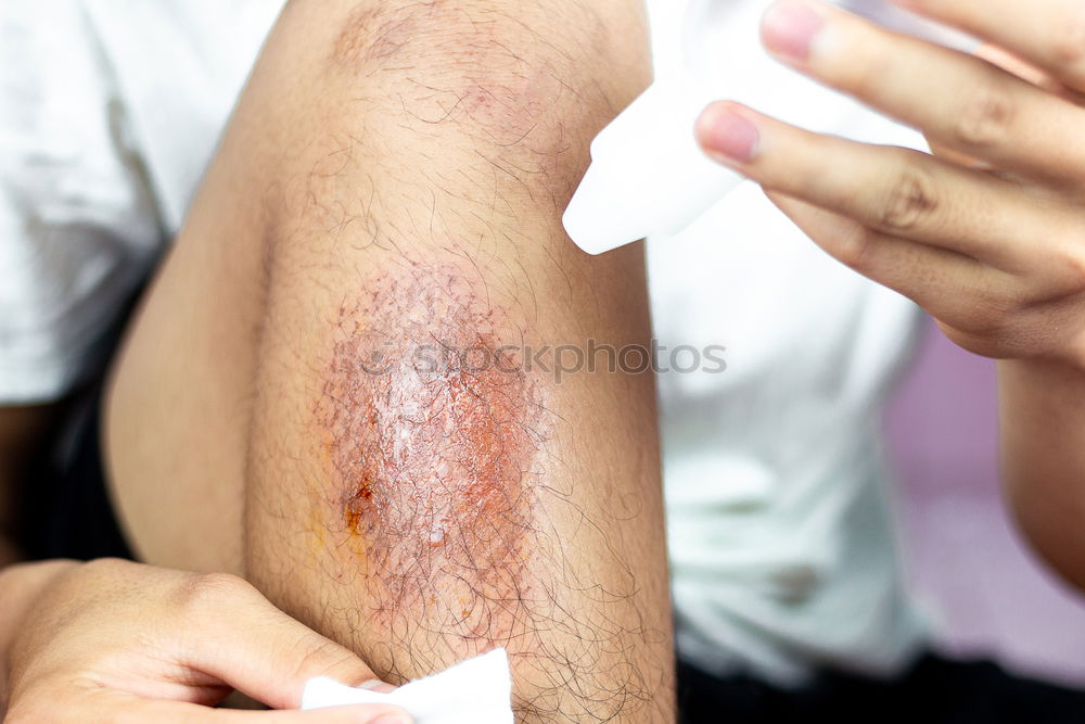 Similar – Image, Stock Photo abrasive wound Human being