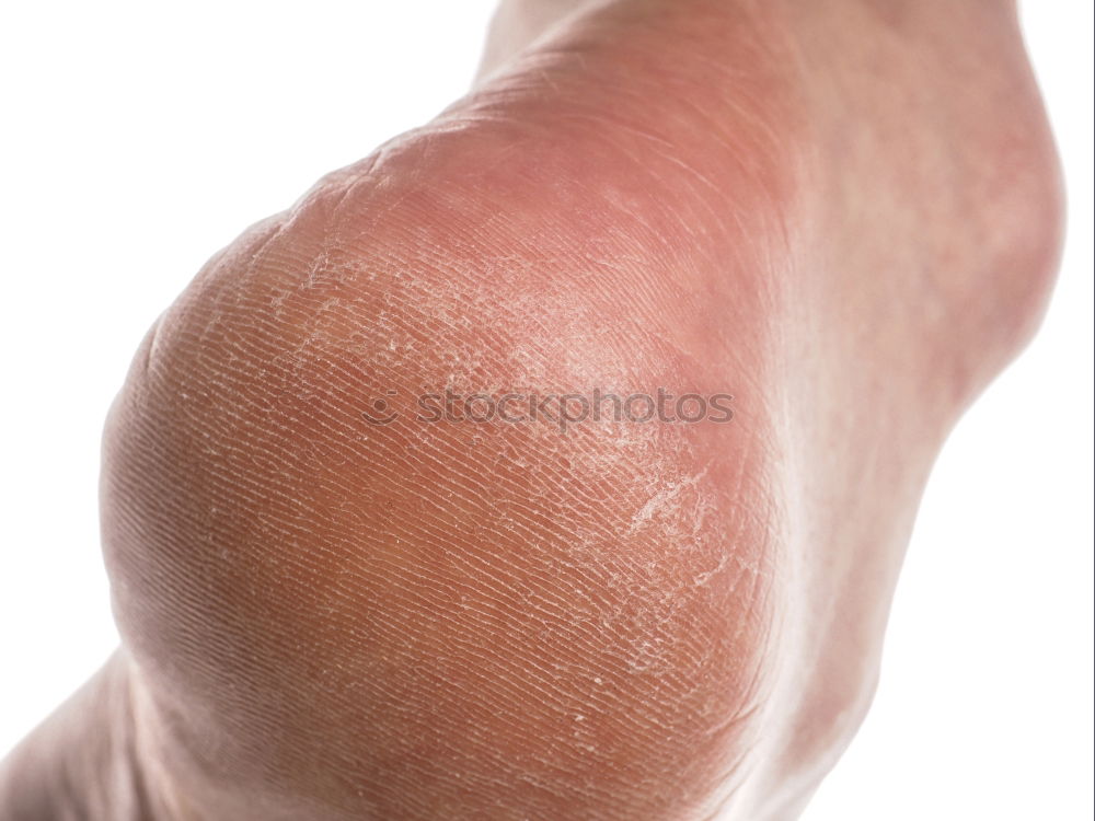 Similar – Image, Stock Photo abrasive wound Human being