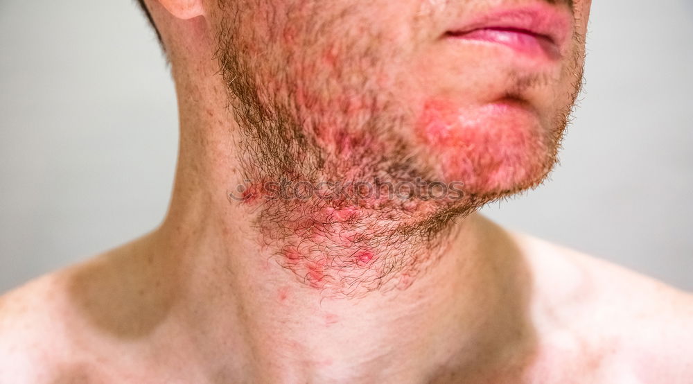 Similar – man’s chin with seborrheic dermatitis in beard