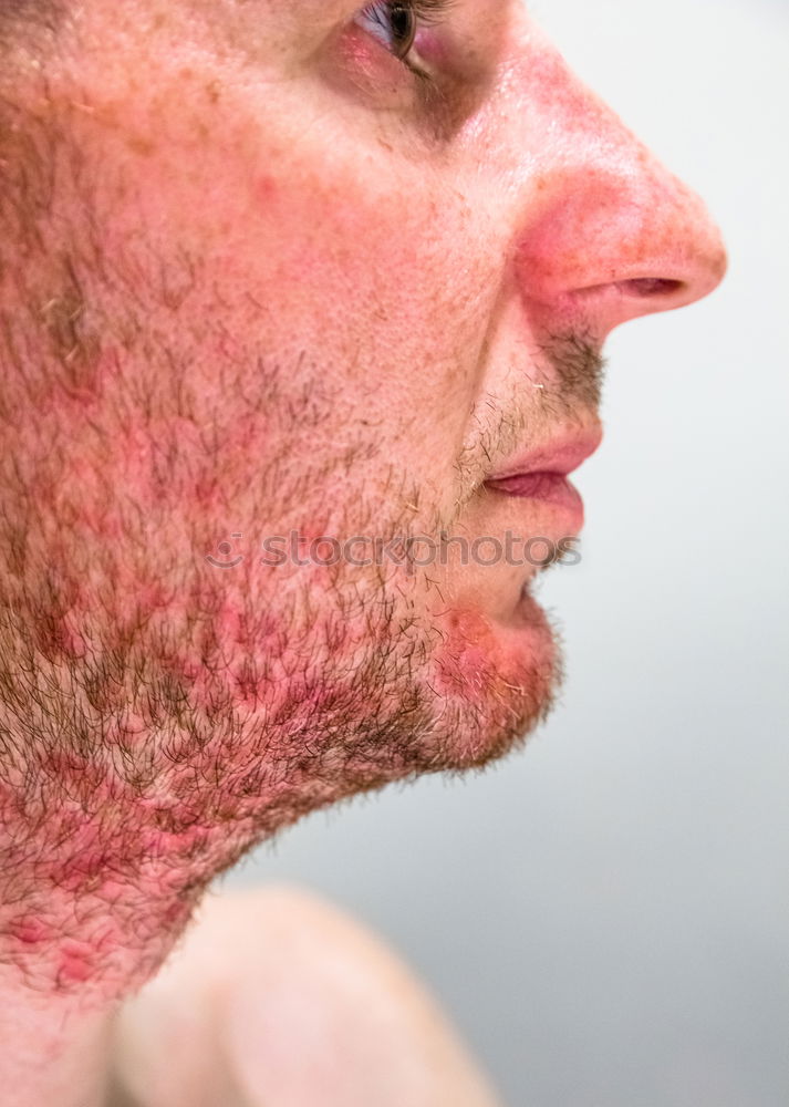 man’s chin with seborrheic dermatitis in beard