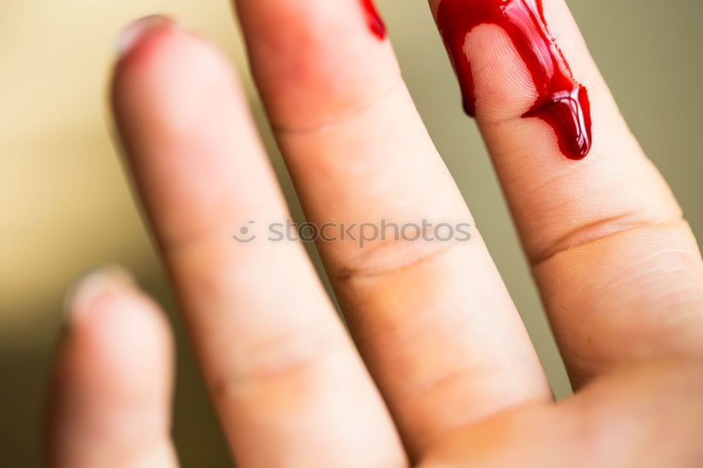 Finger cut, bleeding injured with knife