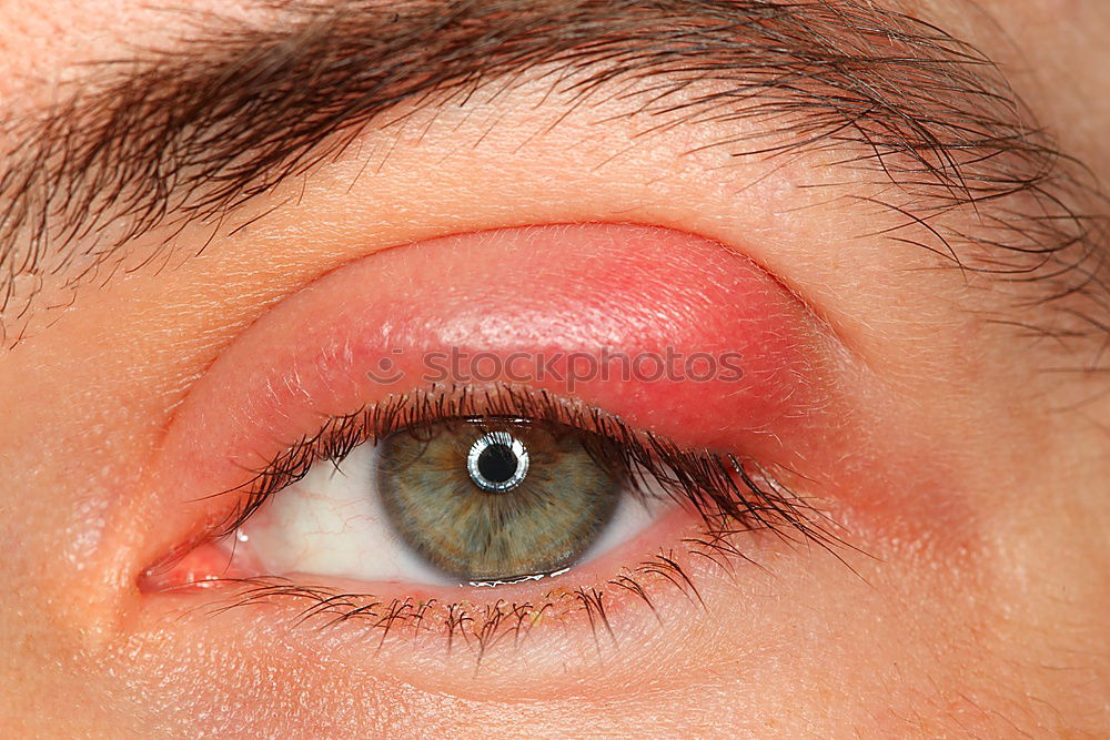 Image, Stock Photo a man with swollen eye from a bee sting