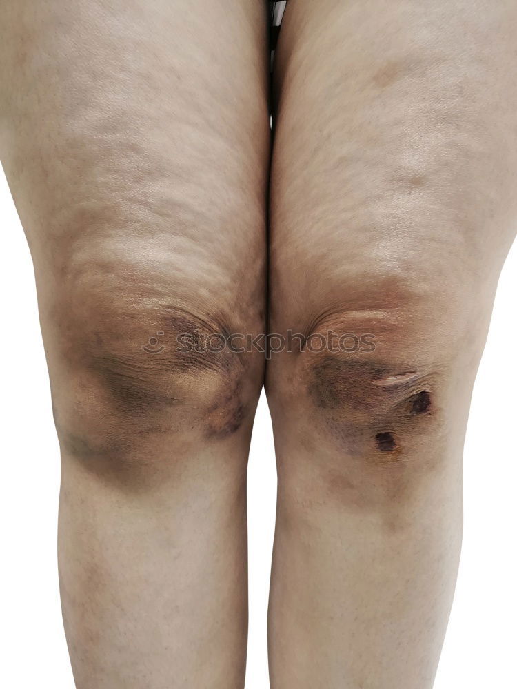 Image, Stock Photo abrasive wound Human being