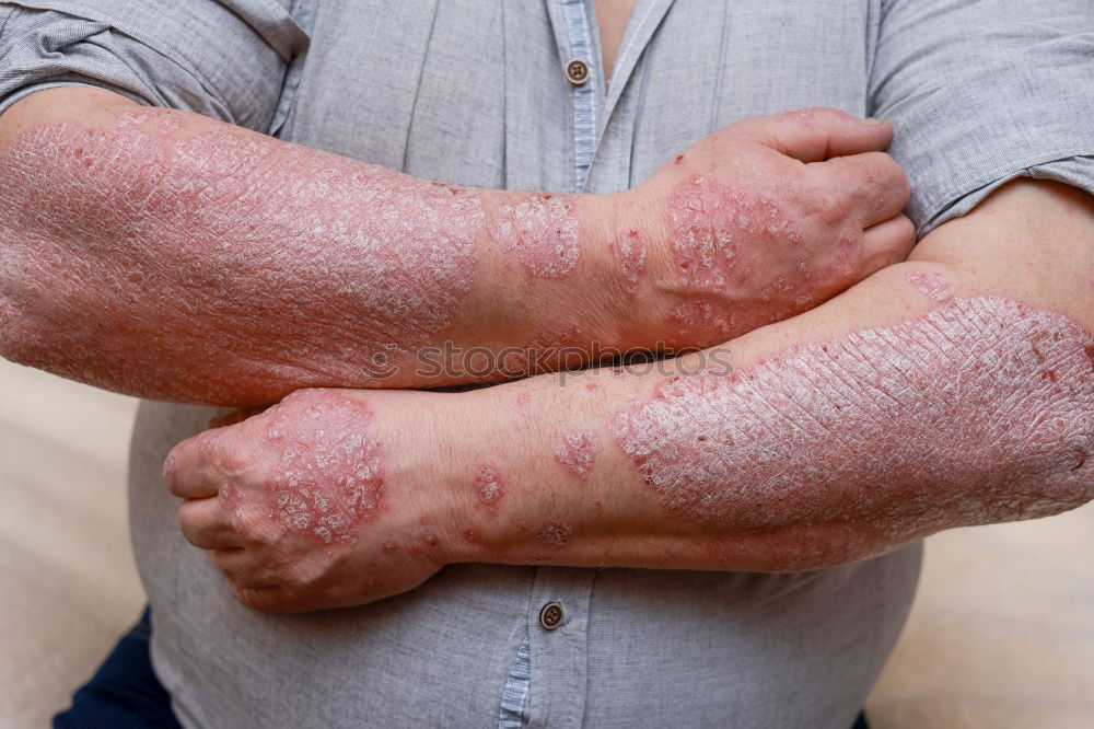 Similar – Foto Bild Mann mit krankem Arm, trockener schuppiger Haut an der Hand mit vulgären Psoriasis-Wunden, Allergie, Ekzem und anderen Hautkrankheiten wie Pilz, Plaque, Ausschlag und Unreinheiten. Genetische Autoimmunerkrankung.