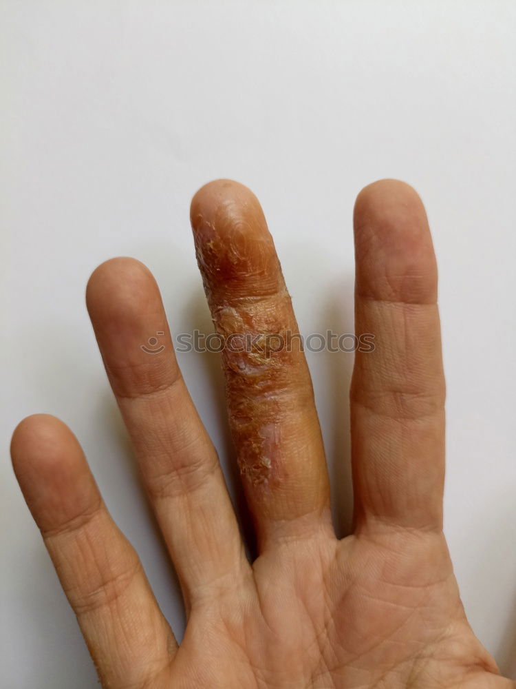 Similar – Foto Bild Mückenstich Hand