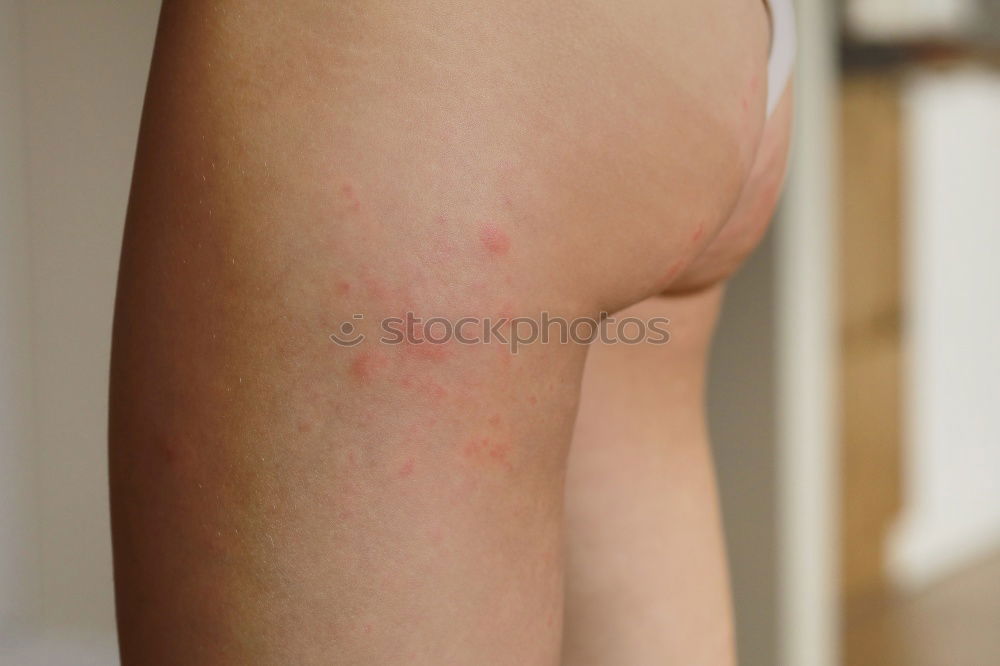 Similar – Foto Bild Mann mit krankem Arm, trockener schuppiger Haut an der Hand mit vulgären Psoriasis-Wunden, Allergie, Ekzem und anderen Hautkrankheiten wie Pilz, Plaque, Ausschlag und Unreinheiten. Genetische Autoimmunerkrankung.