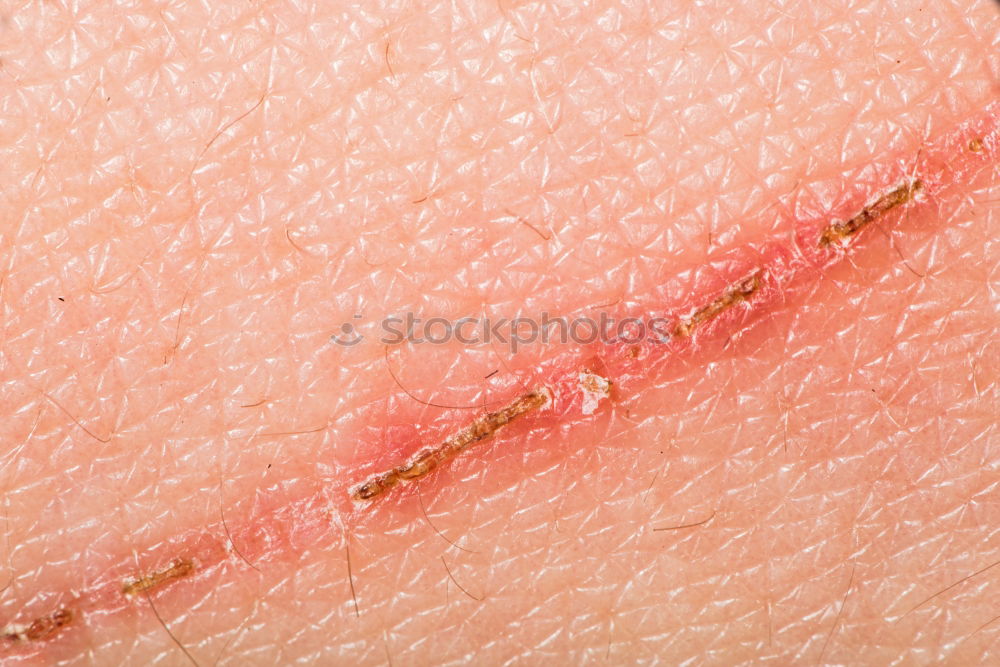 Similar – Foto Bild Mann mit krankem Arm, trockener schuppiger Haut an der Hand mit vulgären Psoriasis-Wunden, Allergie, Ekzem und anderen Hautkrankheiten wie Pilz, Plaque, Ausschlag und Unreinheiten. Genetische Autoimmunerkrankung.