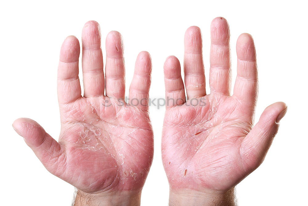 shriveled hands Hand