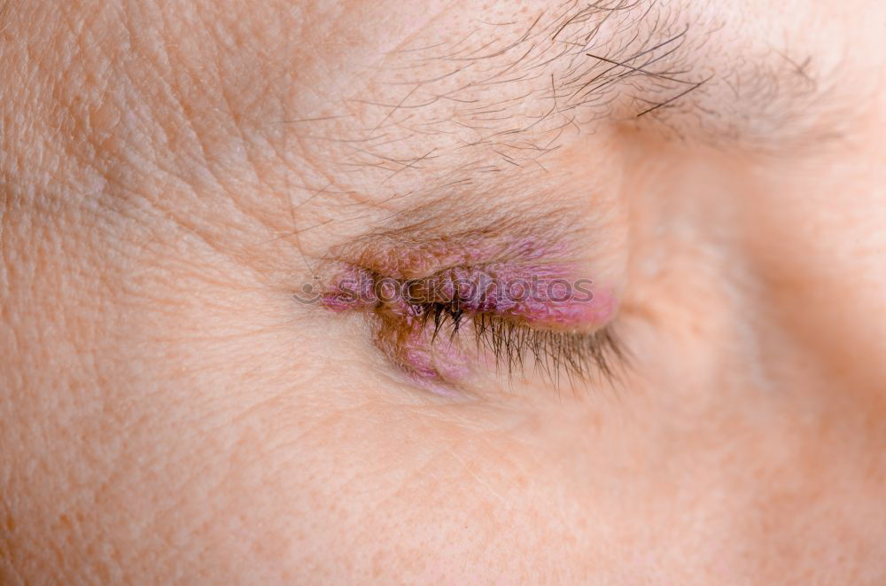 Similar – Image, Stock Photo a man with swollen eye from a bee sting
