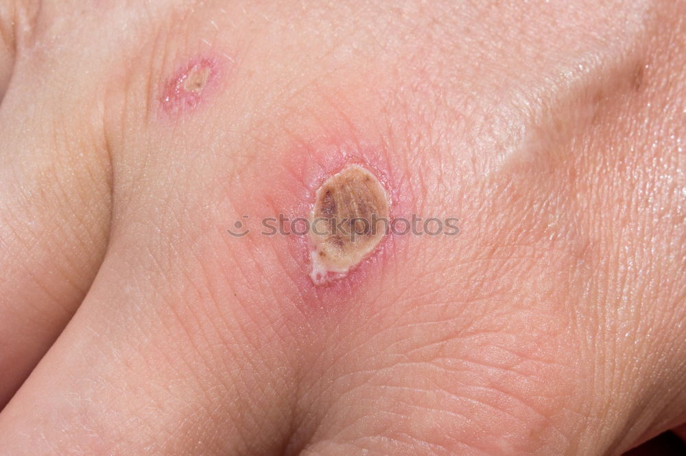 Similar – Foto Bild Mann mit krankem Arm, trockener schuppiger Haut an der Hand mit vulgären Psoriasis-Wunden, Allergie, Ekzem und anderen Hautkrankheiten wie Pilz, Plaque, Ausschlag und Unreinheiten. Genetische Autoimmunerkrankung.